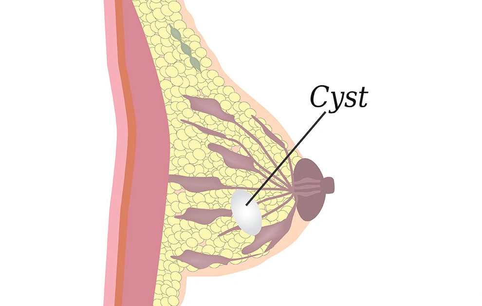 teynampet breast cancer center