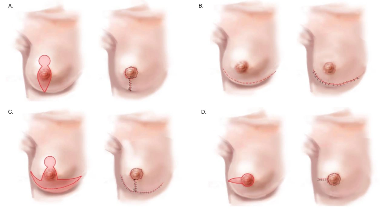 breast Cosmetic surgery in teynampet