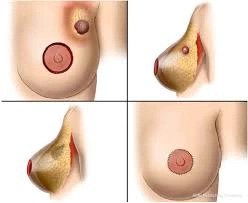 breast augmentation surgery in chennai