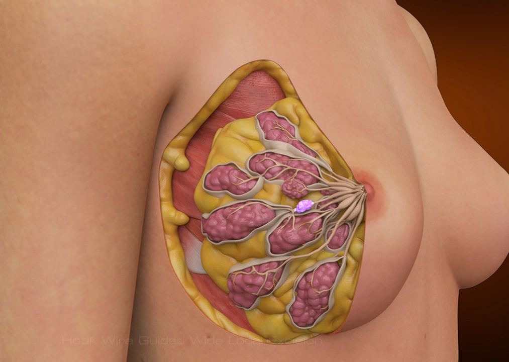 breast reconstruction specialist in alwarpet